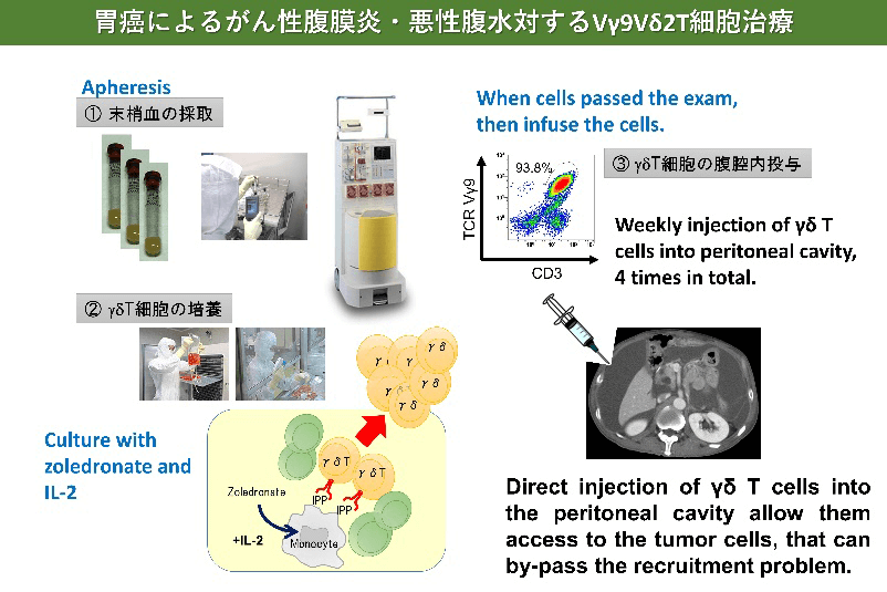 胃癌によるがん性腹膜炎・悪性腹水対するVγ9Vδ2T細胞治療