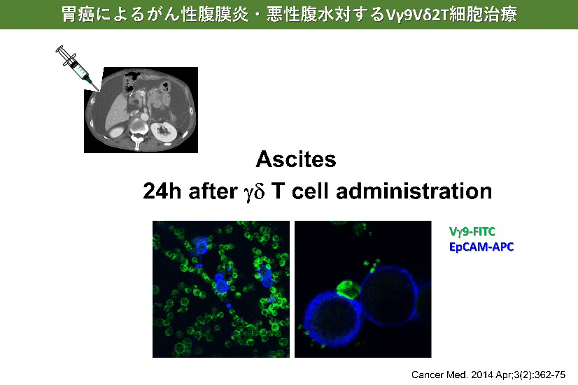 胃癌によるがん性腹膜炎・悪性腹水対するVγ9Vδ2T細胞治療
