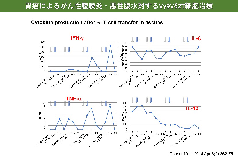 胃癌によるがん性腹膜炎・悪性腹水対するVγ9Vδ2T細胞治療