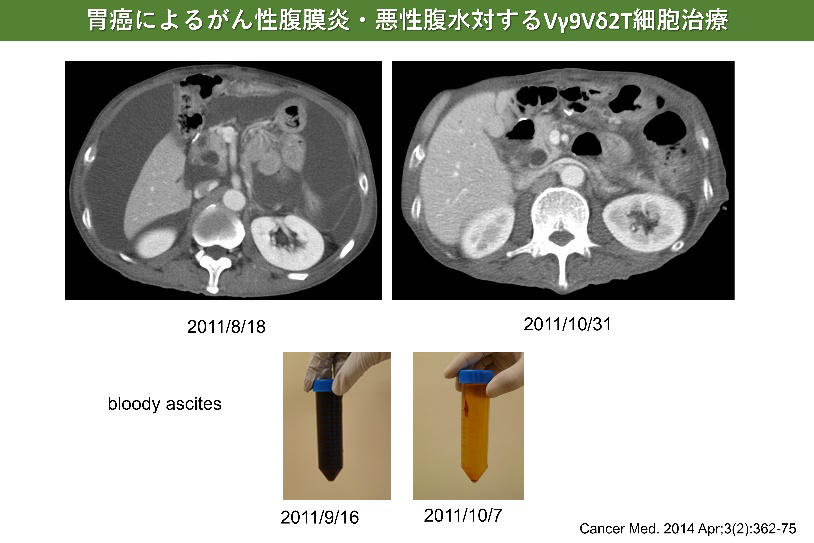 胃癌によるがん性腹膜炎・悪性腹水対するVγ9Vδ2T細胞治療