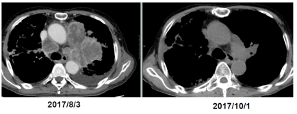 強い免疫反応とともに腫瘍縮小を認めた症例